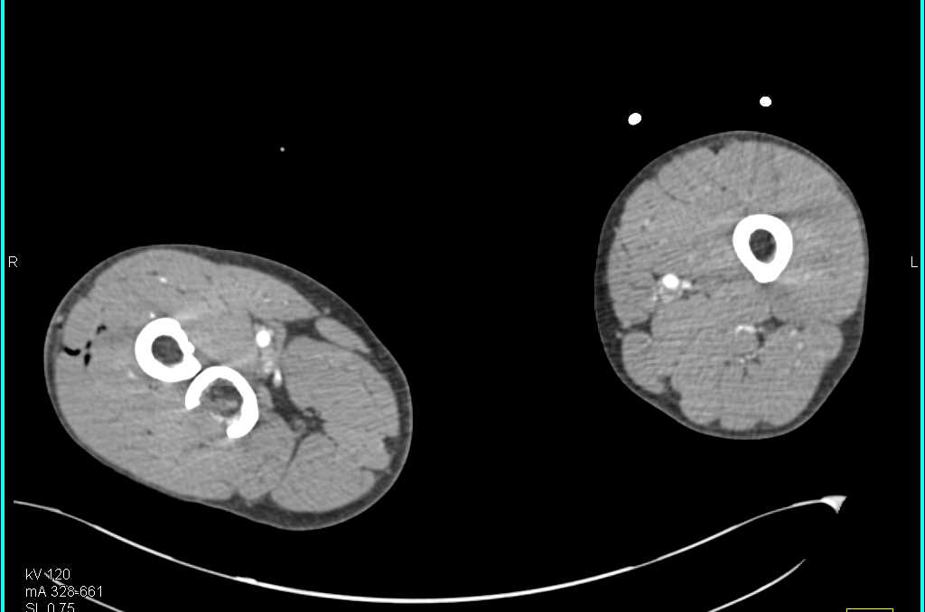 Gunshot to Thigh With Femur Fracture but Intact Vasculature - CTisus CT Scan