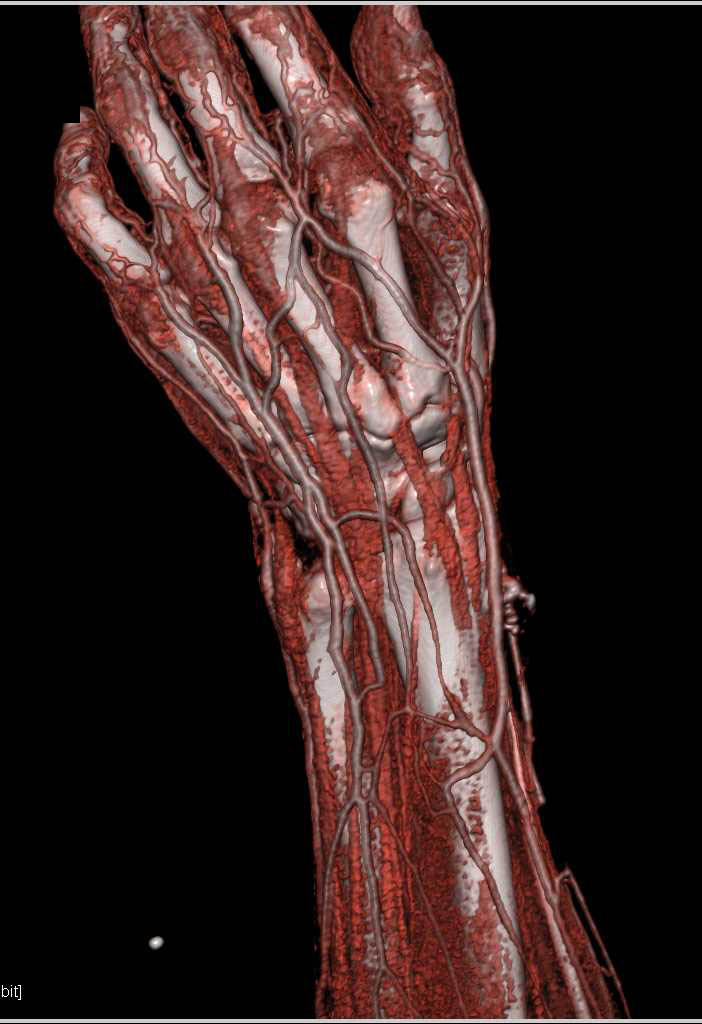 CTA Wrist Post GSW with Dual Energy Edit - CTisus CT Scan
