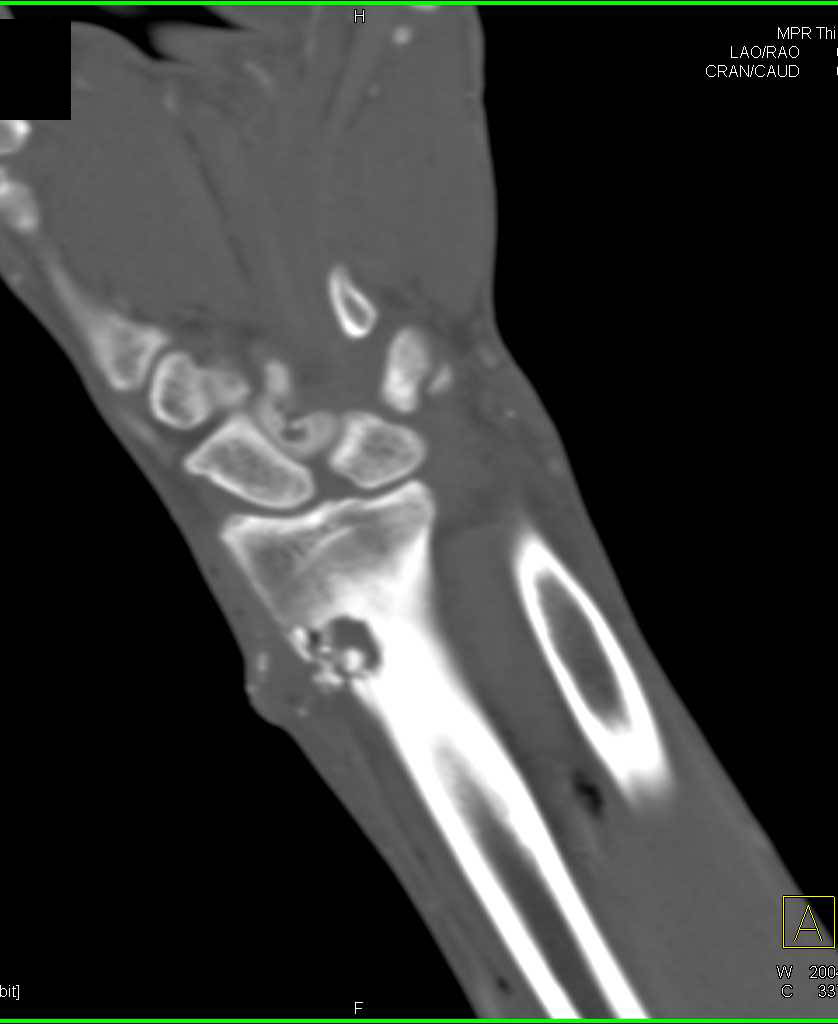 Vascular Spasm s/p GSW - CTisus CT Scan