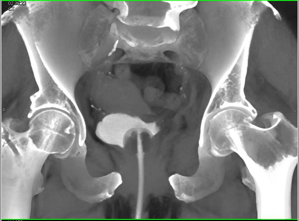 Symphysis Fracture Without Bladder Injury - CTisus CT Scan