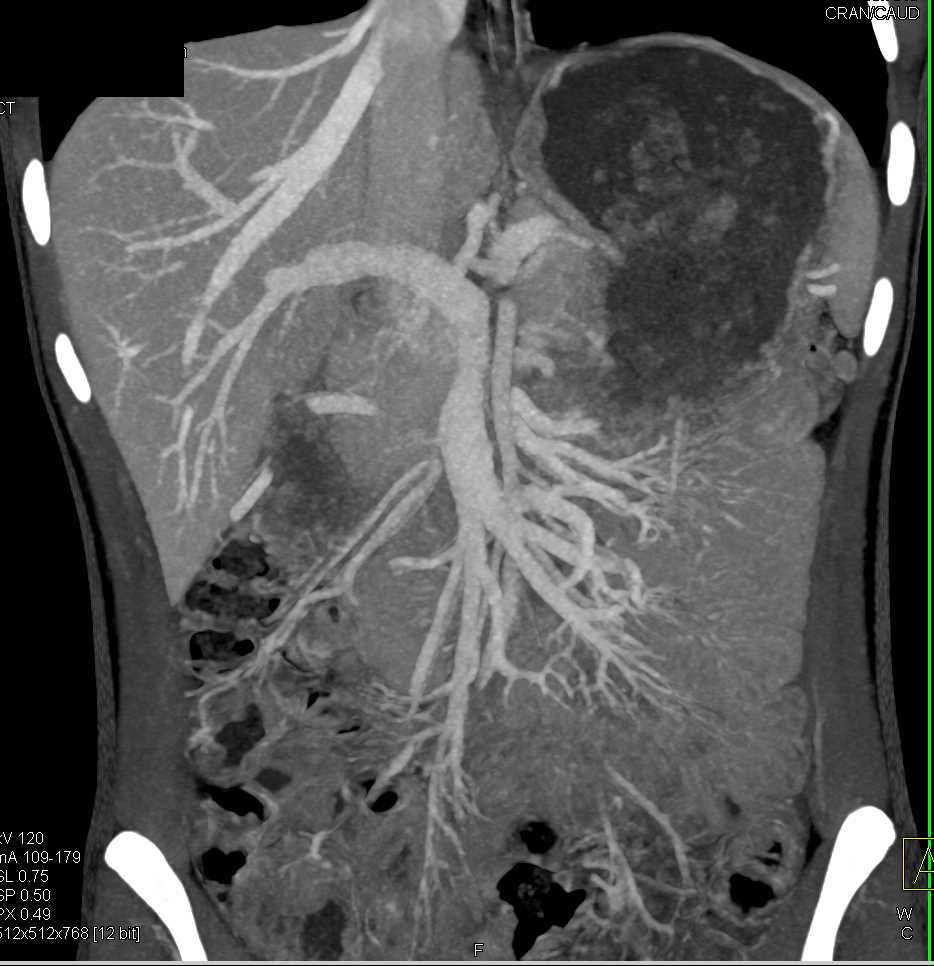 Hepatic Laceration - CTisus CT Scan