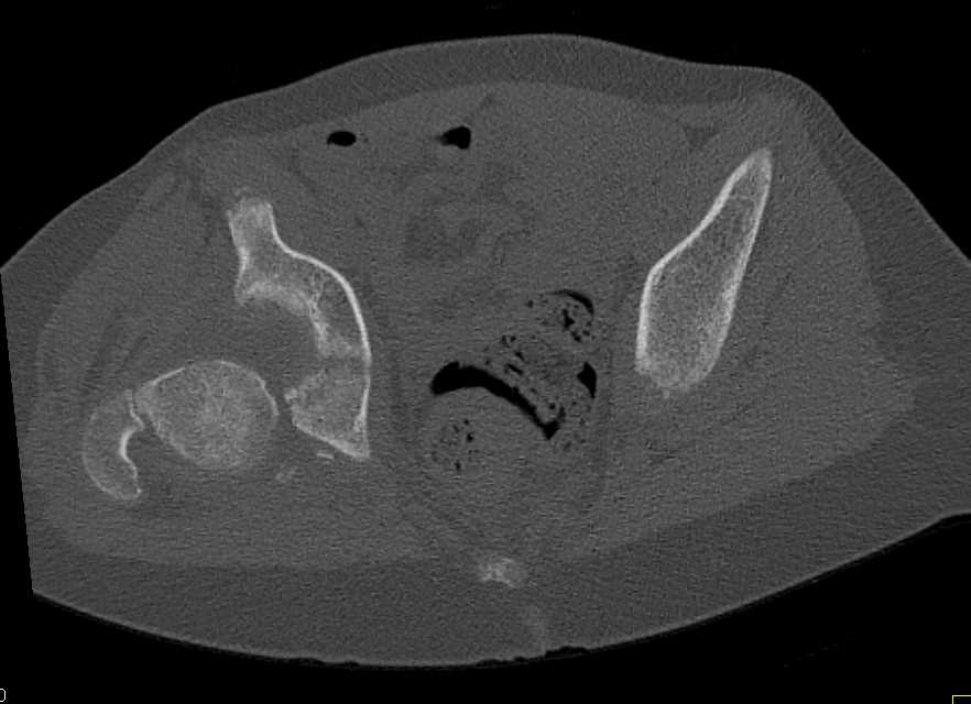 Right Hip Fracture/Dislocation - CTisus CT Scan