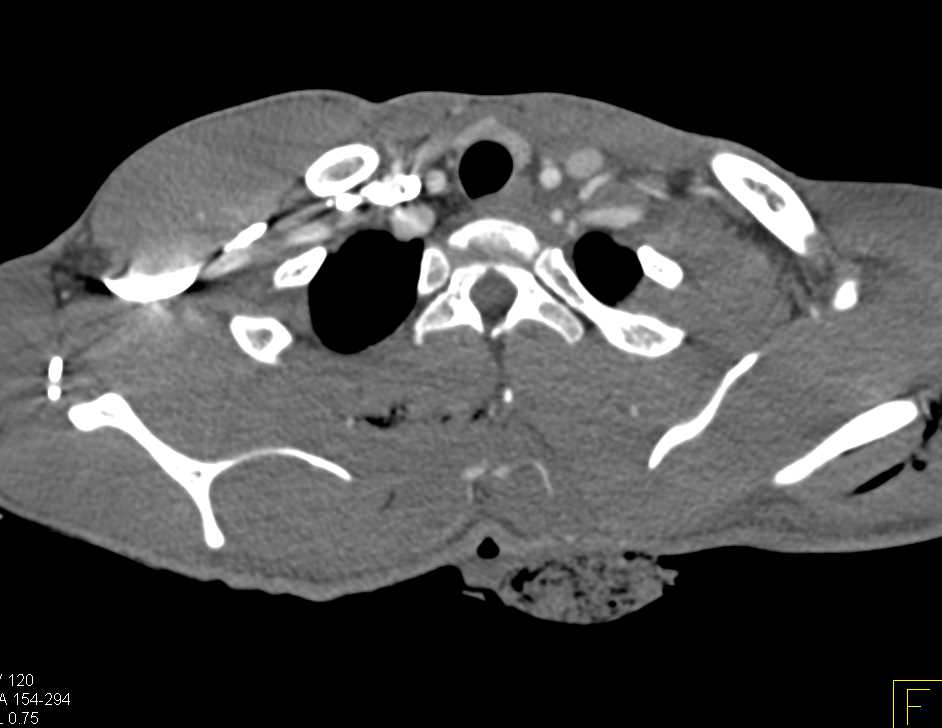 Stab Wound Back with Active Contrast Extravasation - CTisus CT Scan