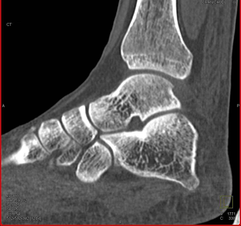 Talus Fracture - CTisus CT Scan