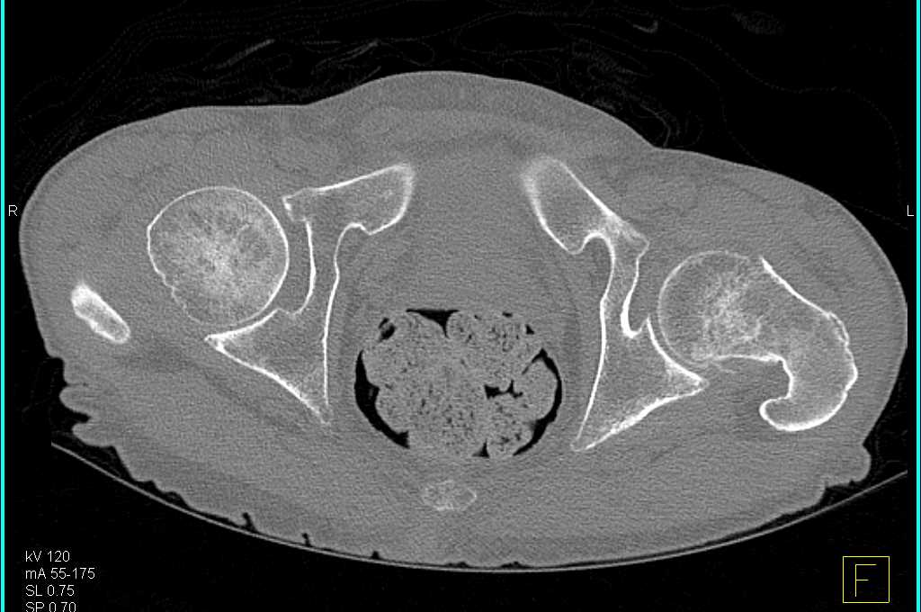 Impacted Fracture Left Femoral Neck - CTisus CT Scan