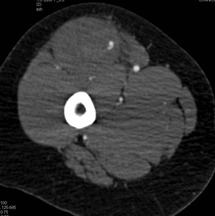 Trauma Thigh with Subtle Active Bleed in the Thigh - CTisus CT Scan