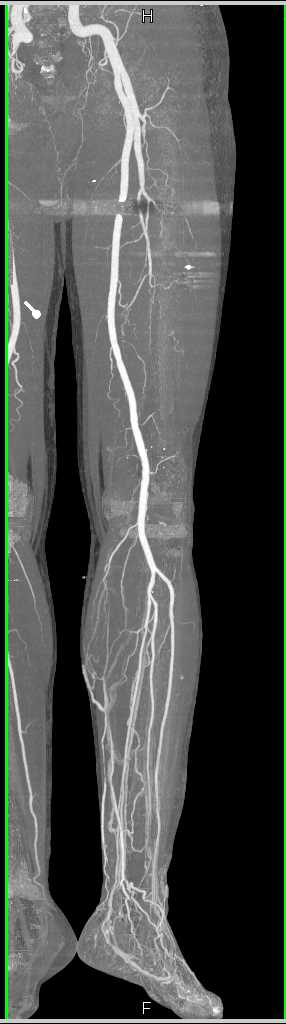 GSW Left Thigh Without Vascular Injury - CTisus CT Scan