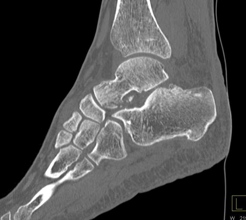 Fracture of the Talus and the Calcaneus - CTisus CT Scan