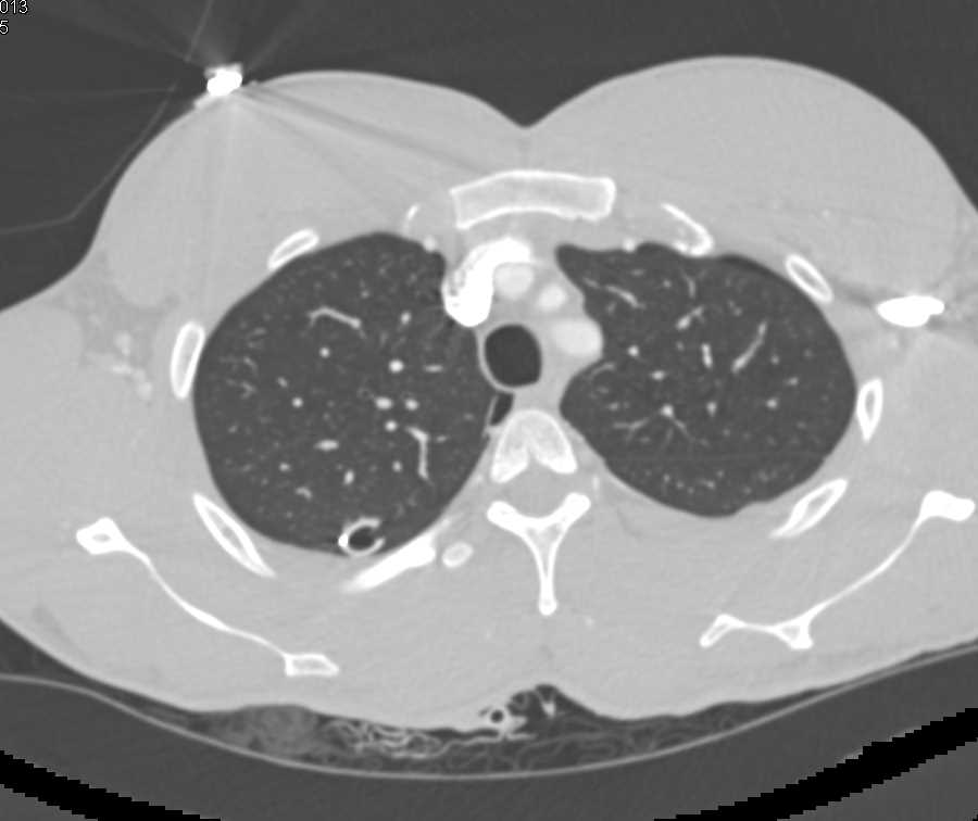 MVA with Pneumothorax and Suspected Colon Injury with Rectal Contrast - CTisus CT Scan