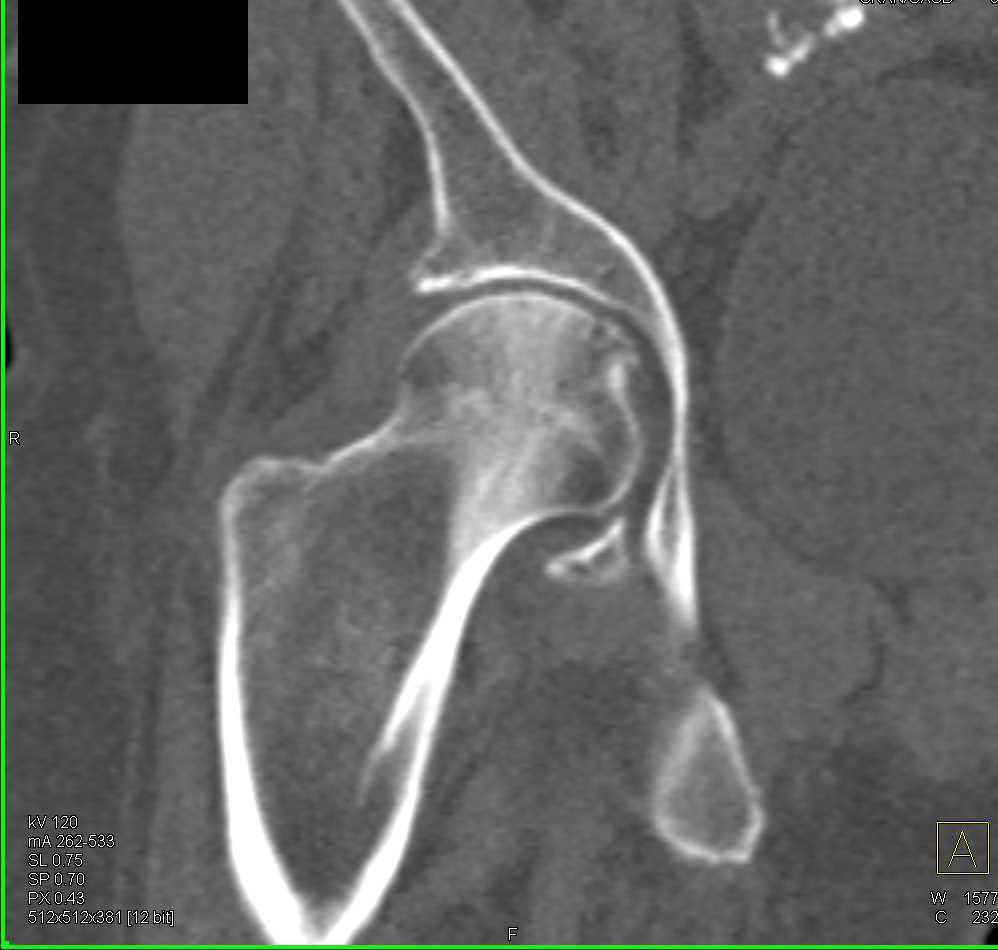 Subtle Fracture Femoral Head - CTisus CT Scan