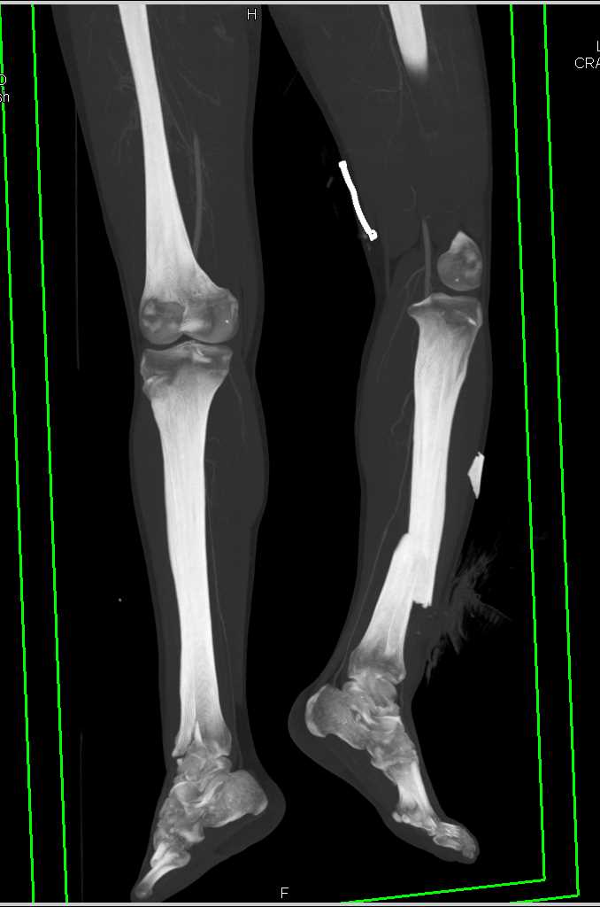 Open Tibial Fracture with Vascular Injury - CTisus CT Scan