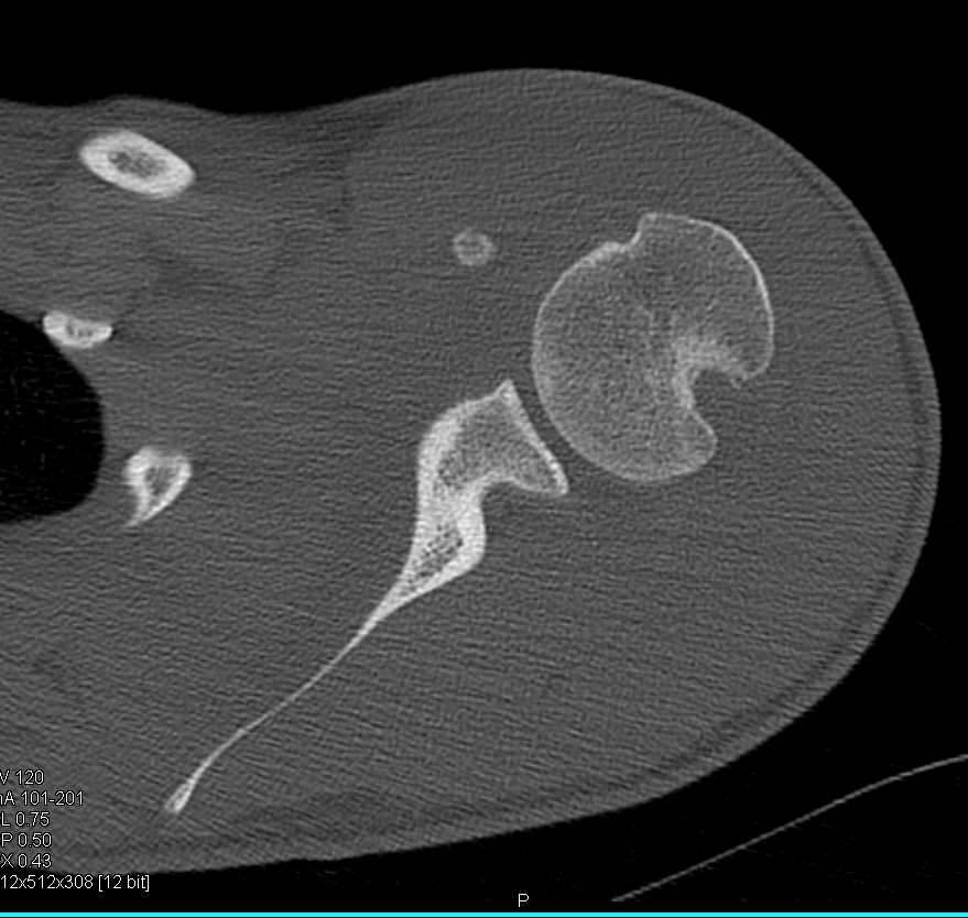 Hill-Sachs Deformity Following Shoulder Fracture/Dislocation - CTisus CT Scan