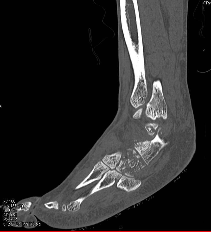 Comminuted Fracture Ankle with Fractures Calcaneus and Talus - CTisus CT Scan