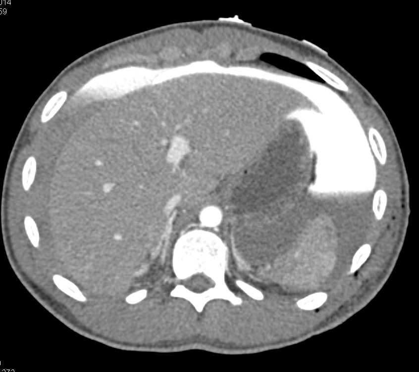 Colon Perforation Following Trauma - CTisus CT Scan