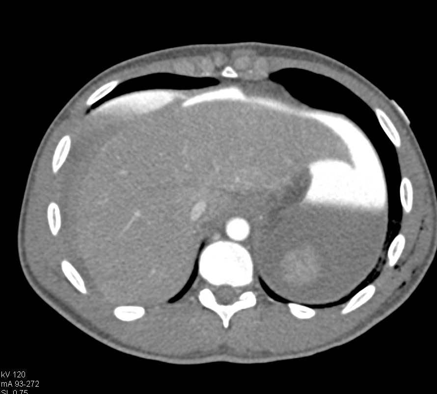 Colon Perforation Following Trauma - CTisus CT Scan
