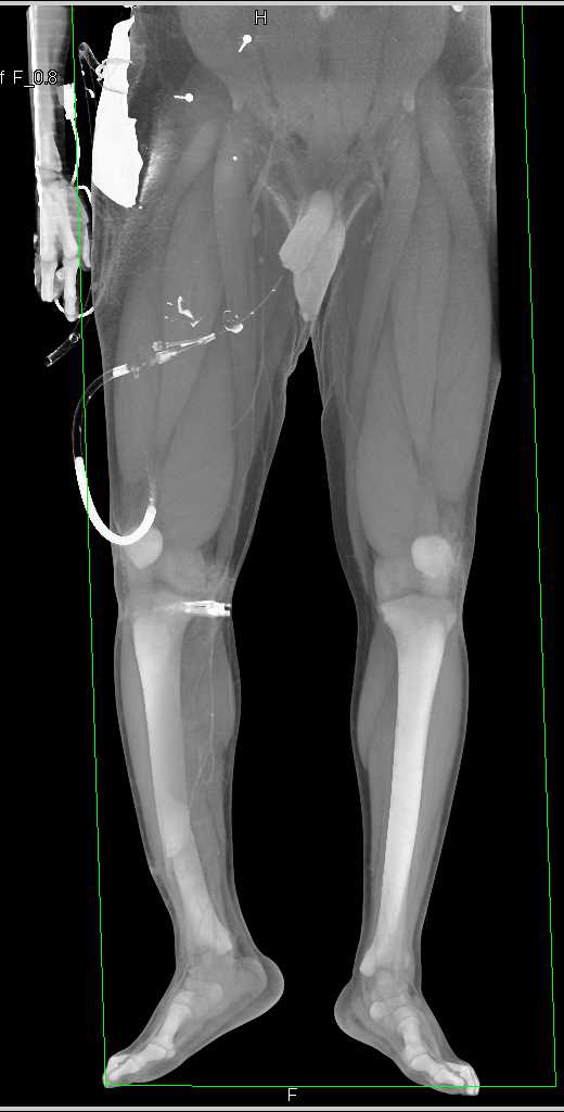 Left Tibial and Fibular Fracture with Compression of Arterial Map - CTisus CT Scan