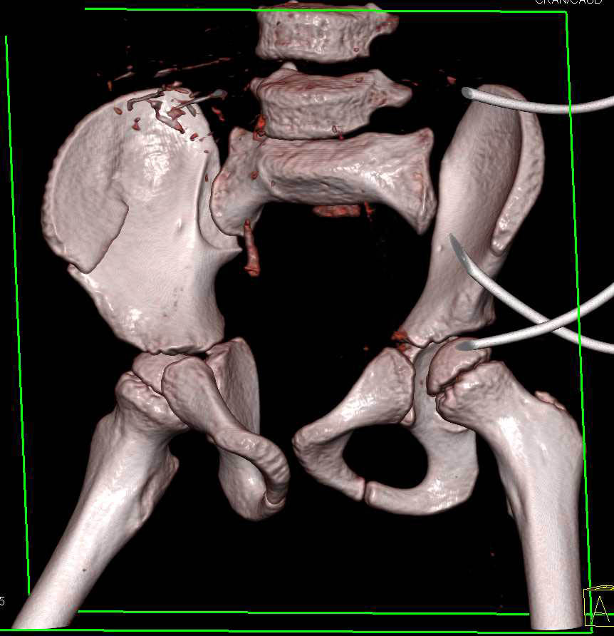 Right Iliac Wing Fracture - CTisus CT Scan