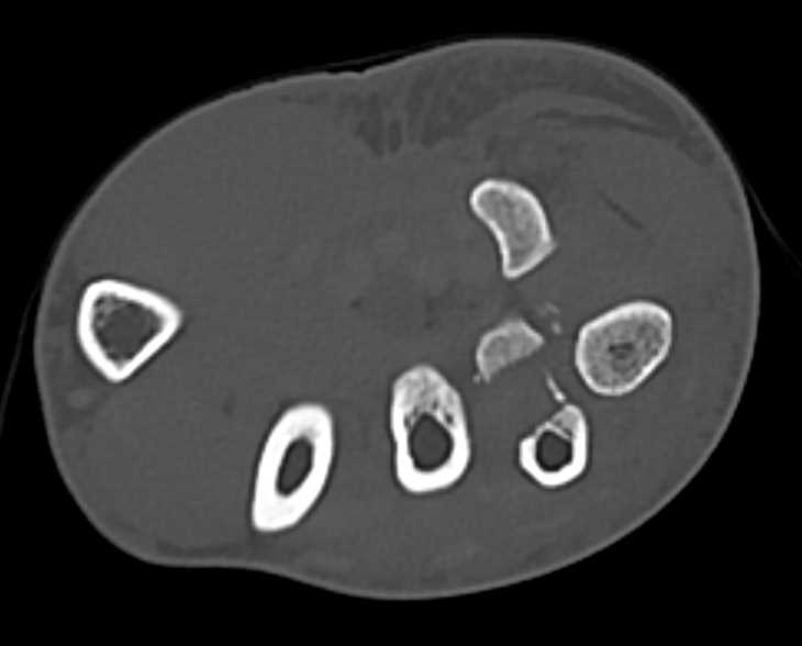 Complex Wrist Trauma with Carpal Fractures in 3D - CTisus CT Scan