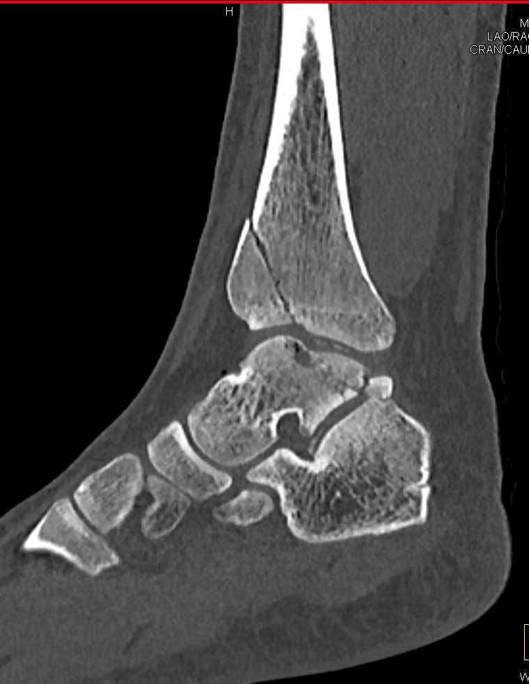 Pulmonary Contusion and Multiple Fractures S/P Trauma - CTisus CT Scan