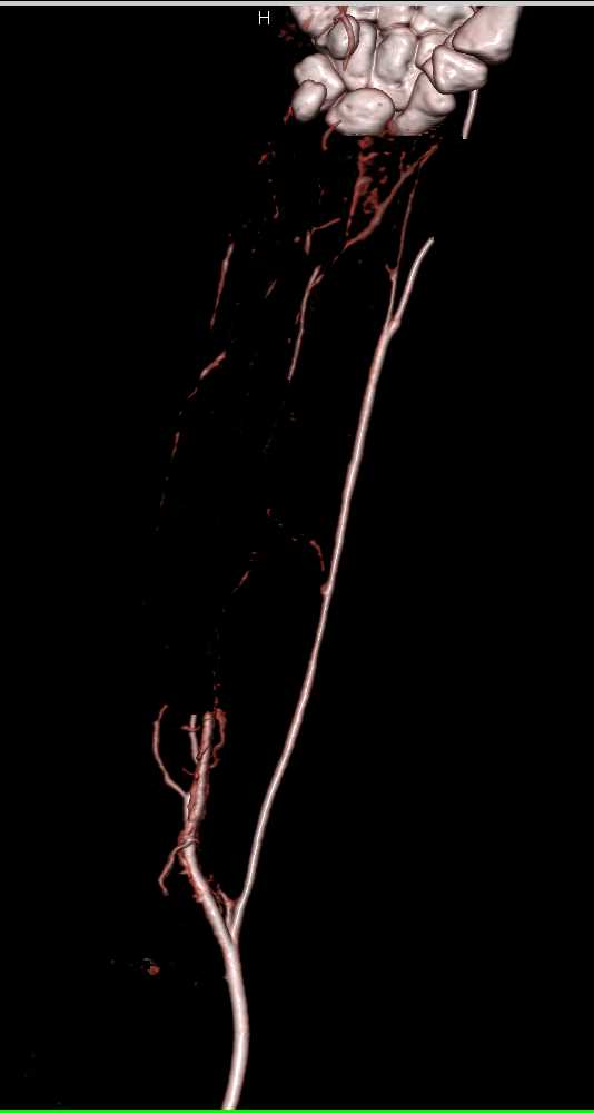 CTA Forearm Post Trauma with Ulnar Artery Occlusion - CTisus CT Scan