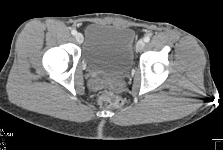 Rectal Injury due to GSW - CTisus CT Scan