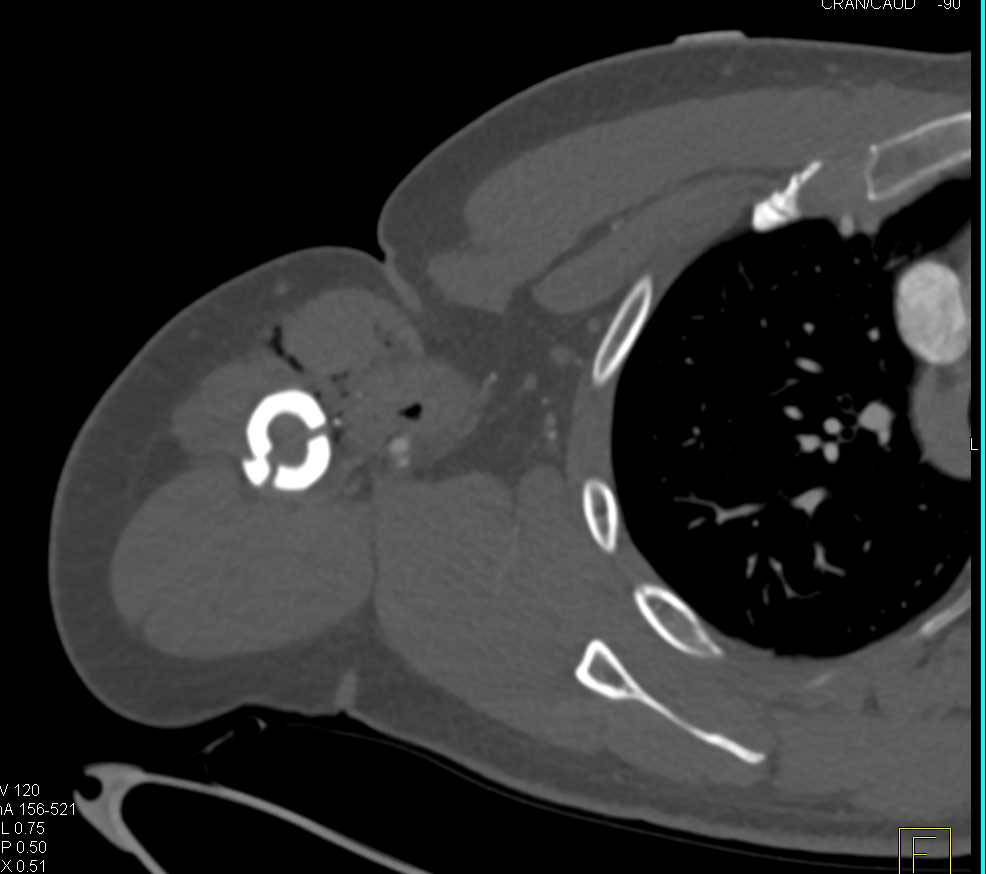 Right Humerus Fracture with Spasm in the Brachial Artery - CTisus CT Scan