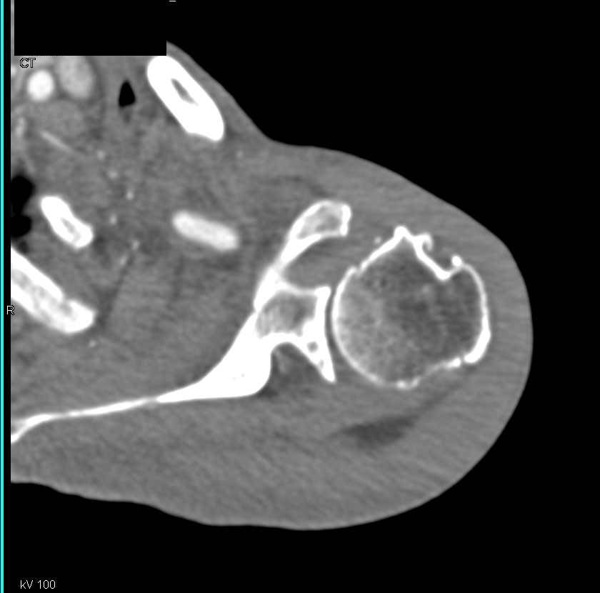 Trauma but no Vascular Injury to the Shoulder - CTisus CT Scan