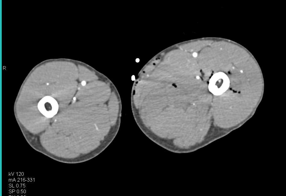 GSW Thigh with Femur Fracture - CTisus CT Scan