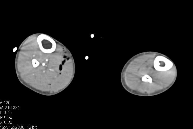 GSW with Femur Fracture and Vascular Injury - CTisus CT Scan