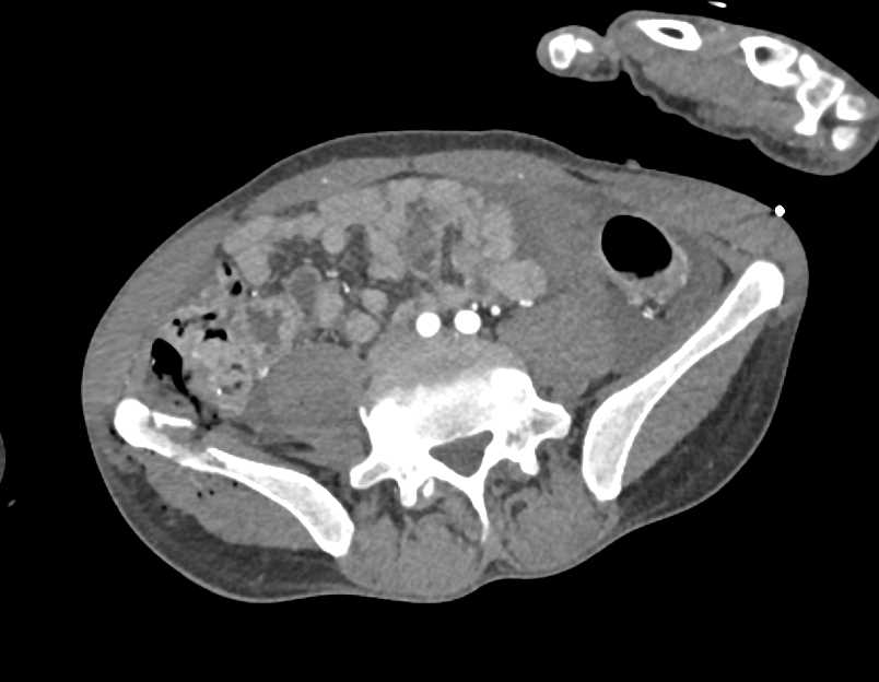 GSW with Cecal Injury and Right Iliac Wing Fracture - CTisus CT Scan