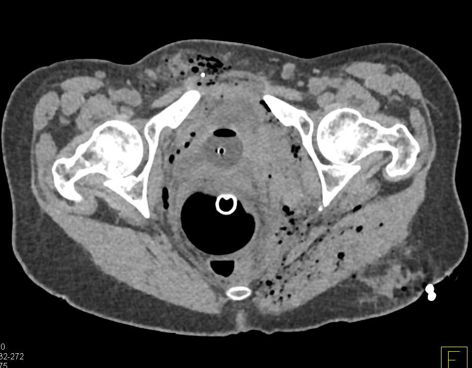 GSW Pelvis with Bladder Hematoma and Contrast Extravasation - CTisus CT Scan