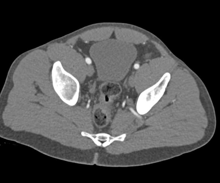 Femur Fractures Without Vascular Injury - CTisus CT Scan