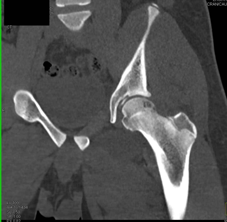 Intra-articular Fragment in the Left Hip Joint Following Left Hip Fracture and Dislocation - CTisus CT Scan