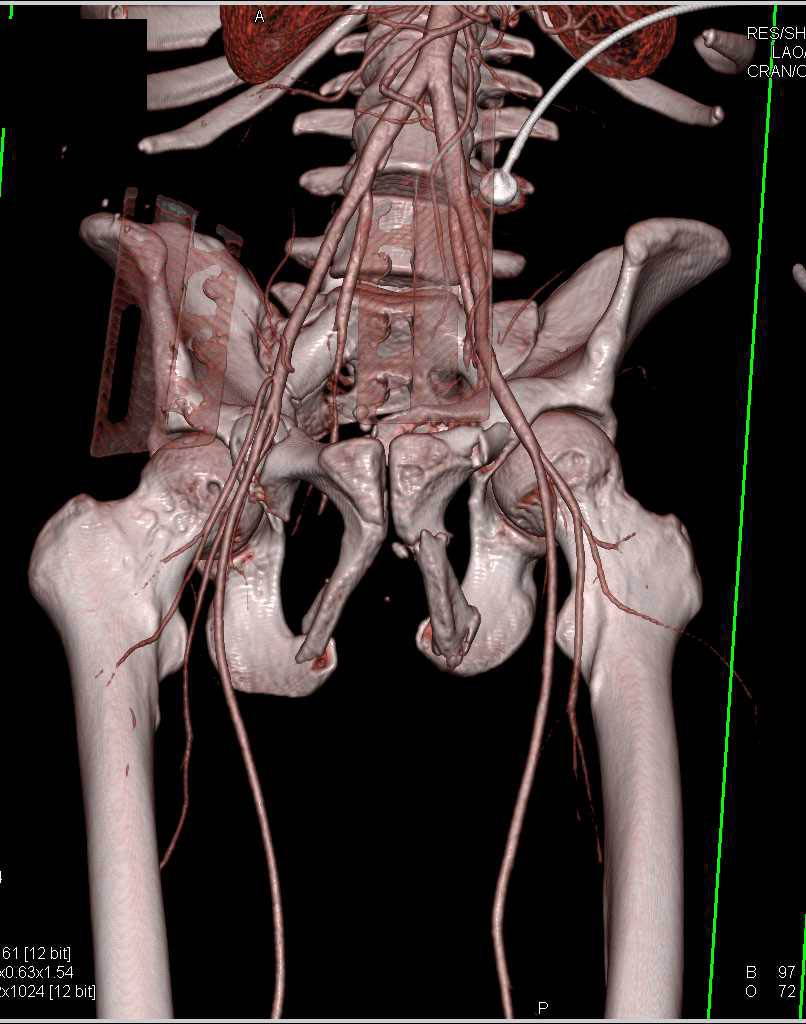 Complex Pelvic Fractures Including Sacrum and Symphysis Bilaterally - CTisus CT Scan