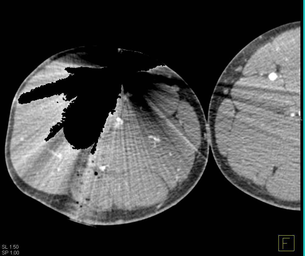 GSW Thigh with Pseudolesion in the Superficial Femoral Artery (SFA) - CTisus CT Scan