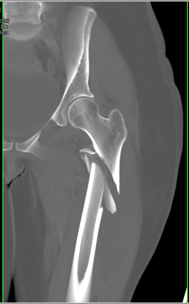 Spiral Femur Fracture Following Fall - CTisus CT Scan