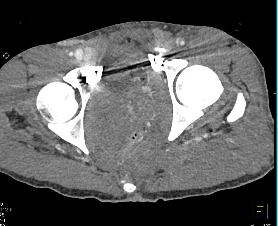 GSW Pelvis with Large Hematoma - CTisus CT Scan