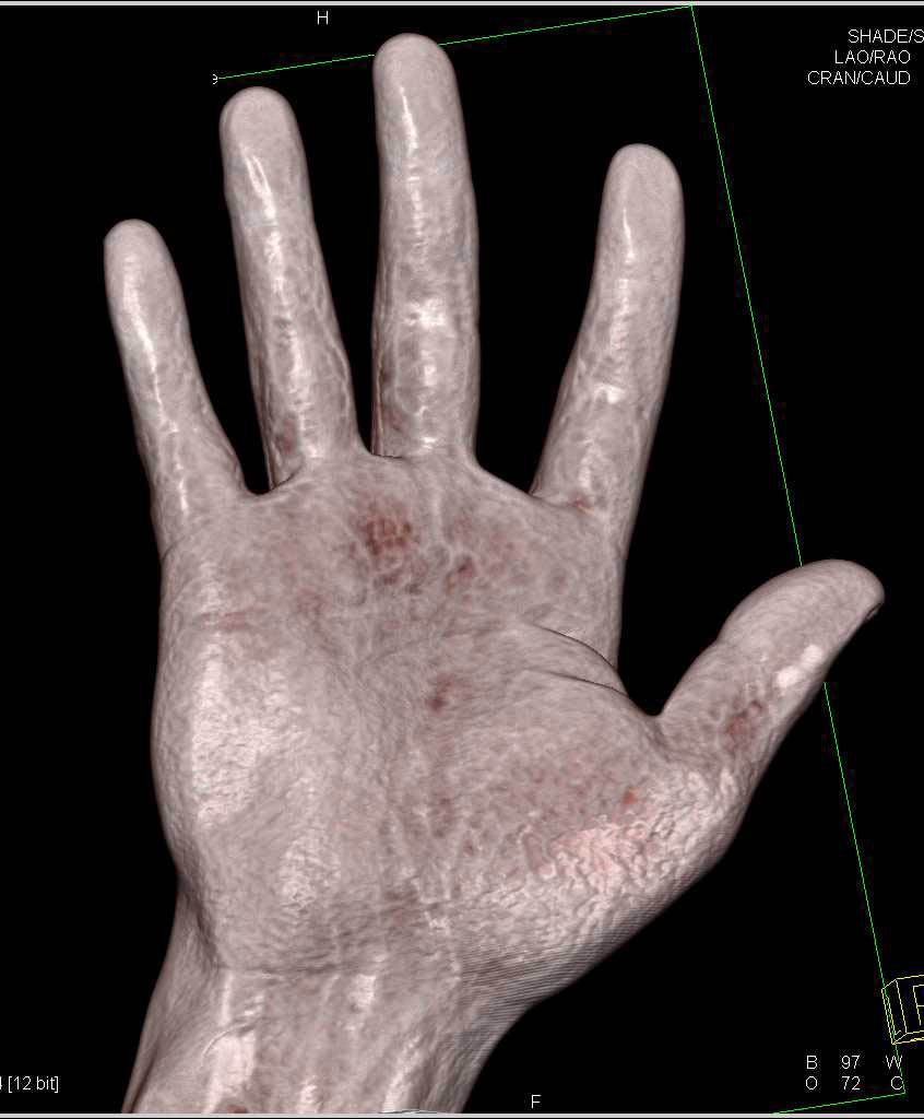 Fracture Proximal Phalanx 5th Digit - CTisus CT Scan