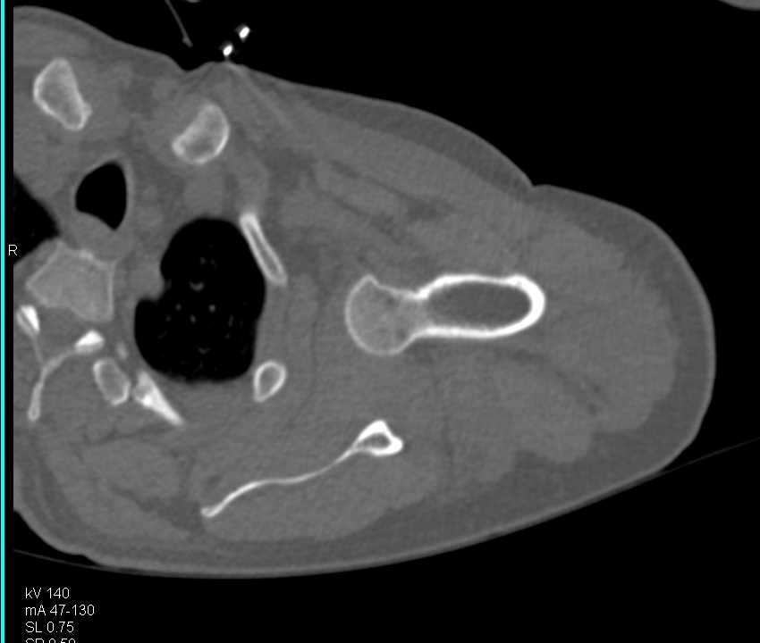 Fracture and Dislocation Left Shoulder with Poor Reduction - CTisus CT Scan