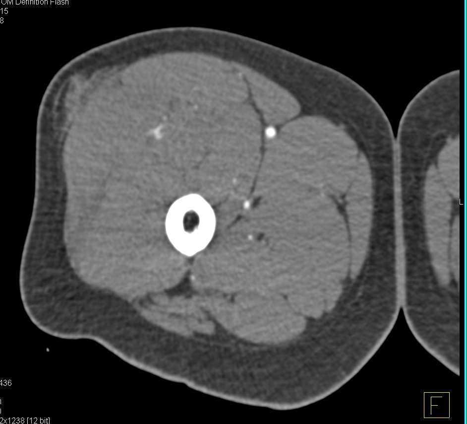 Stab Wound Thigh with Small Vessel Bleed - CTisus CT Scan