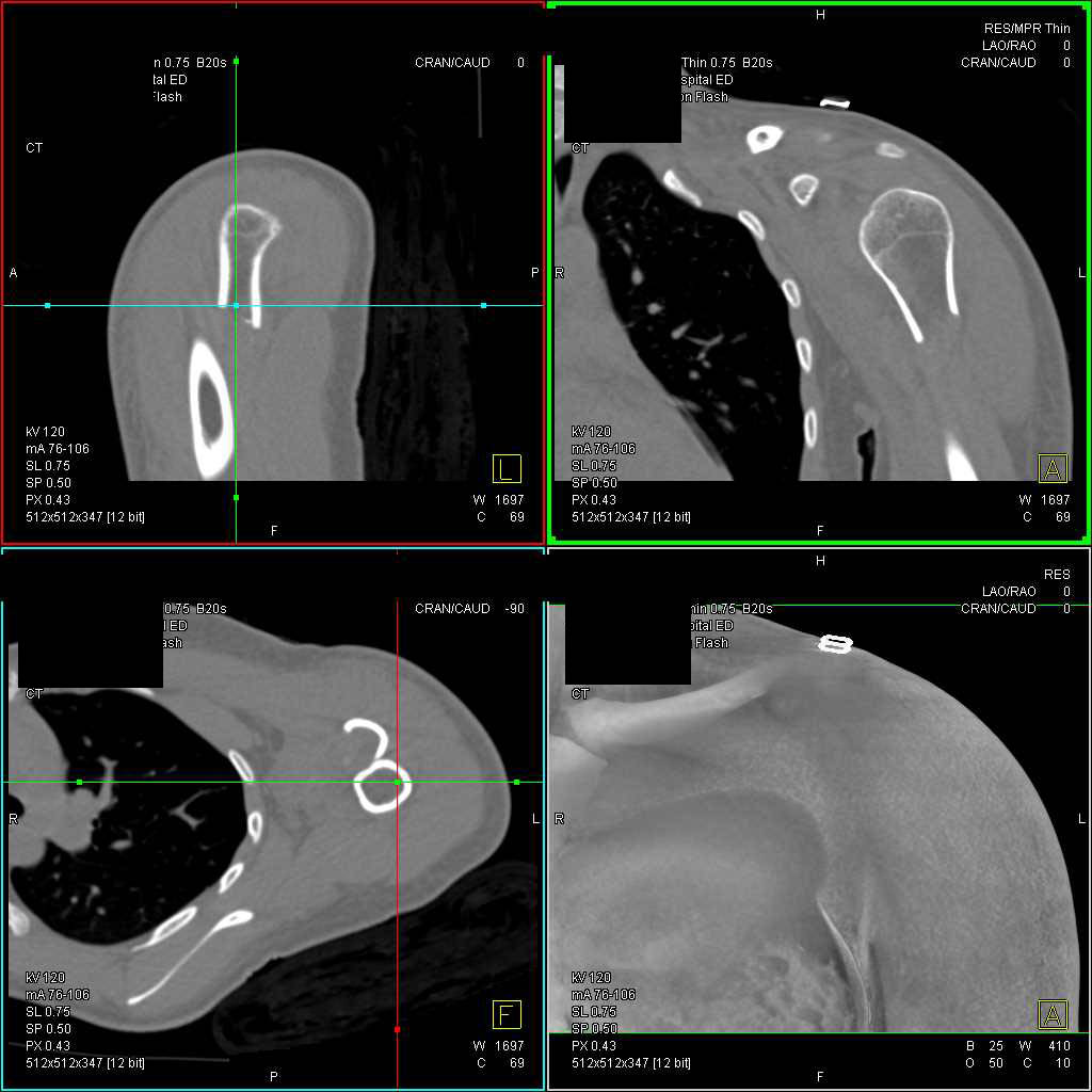 Humerus Fracture - CTisus CT Scan