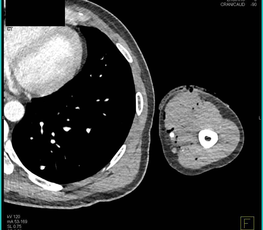 GSW Right Arm Without Vascular Injury - CTisus CT Scan