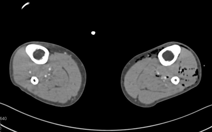 Comminuted Fracture of Left Tibia and Fibula with Vascular Occlusion - CTisus CT Scan