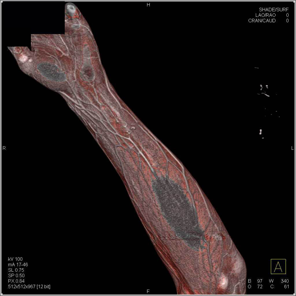 Ulnar Artery Injury Following GSW - CTisus CT Scan