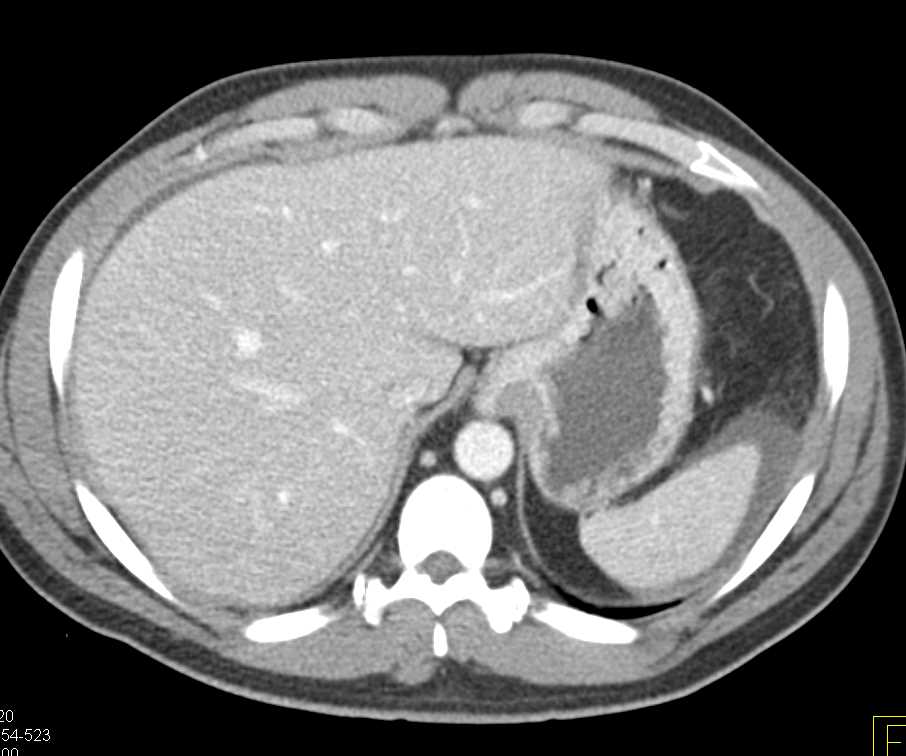 Splenic Laceration and Hemoperitoneum - CTisus CT Scan