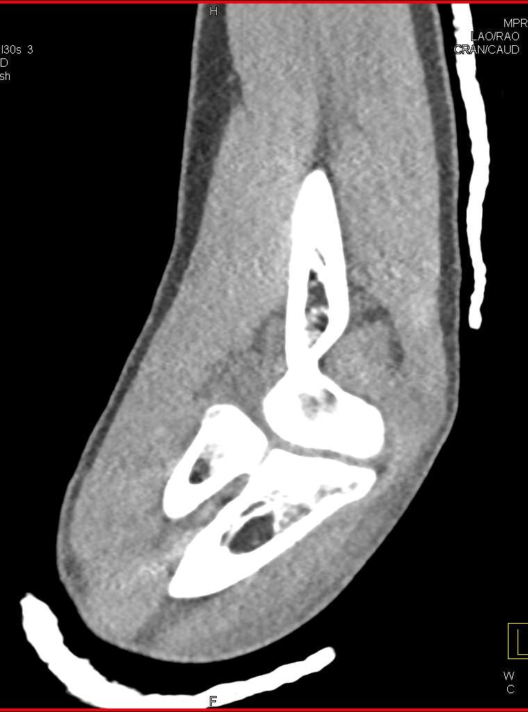 Fat Pad Sign Elbow with Olecranon Fracture - CTisus CT Scan