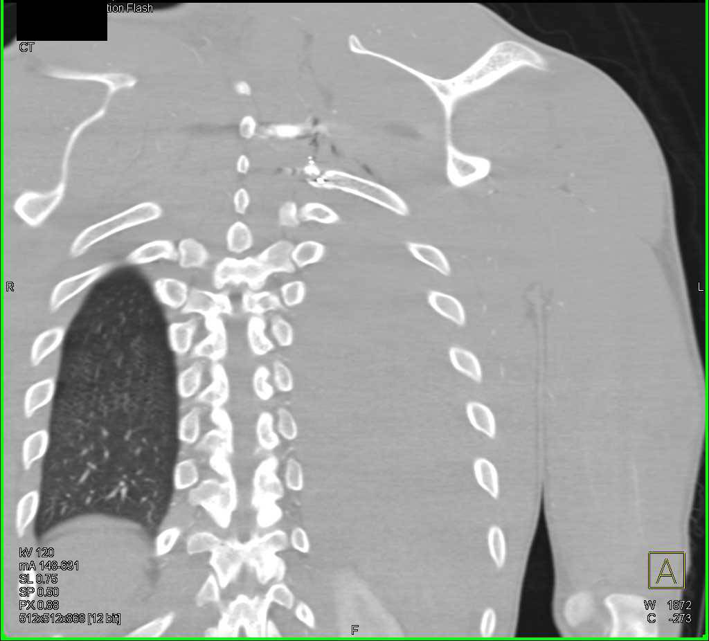 GSW with Lung, Bone and Muscle Injury - CTisus CT Scan