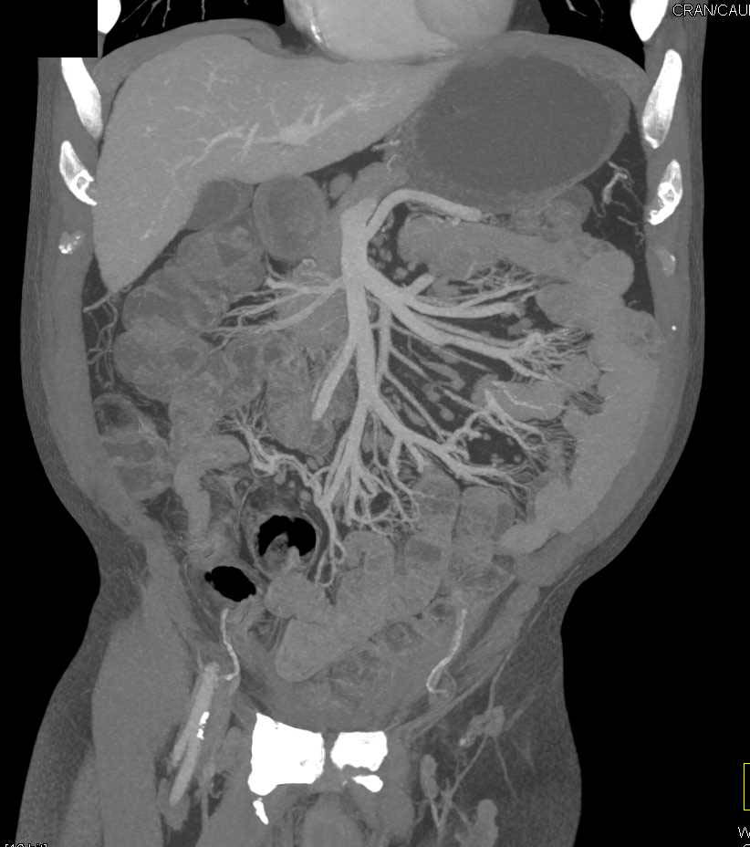 CTA of Femur Fracture Without Vascular Injury - CTisus CT Scan