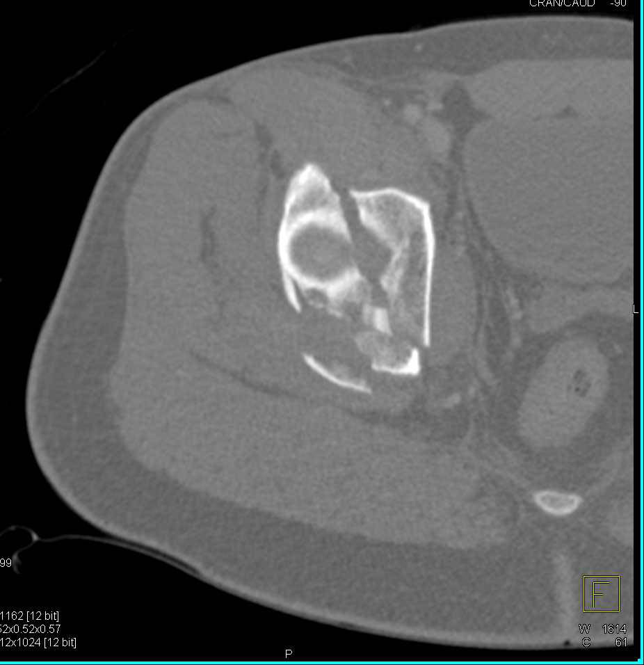 Comminuted Acetabular Fracture with Bone Removal of Femur - CTisus CT Scan