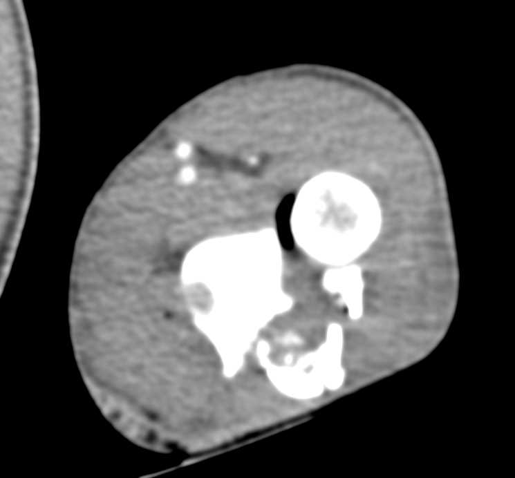 Comminuted Ulnar Fracture - CTisus CT Scan
